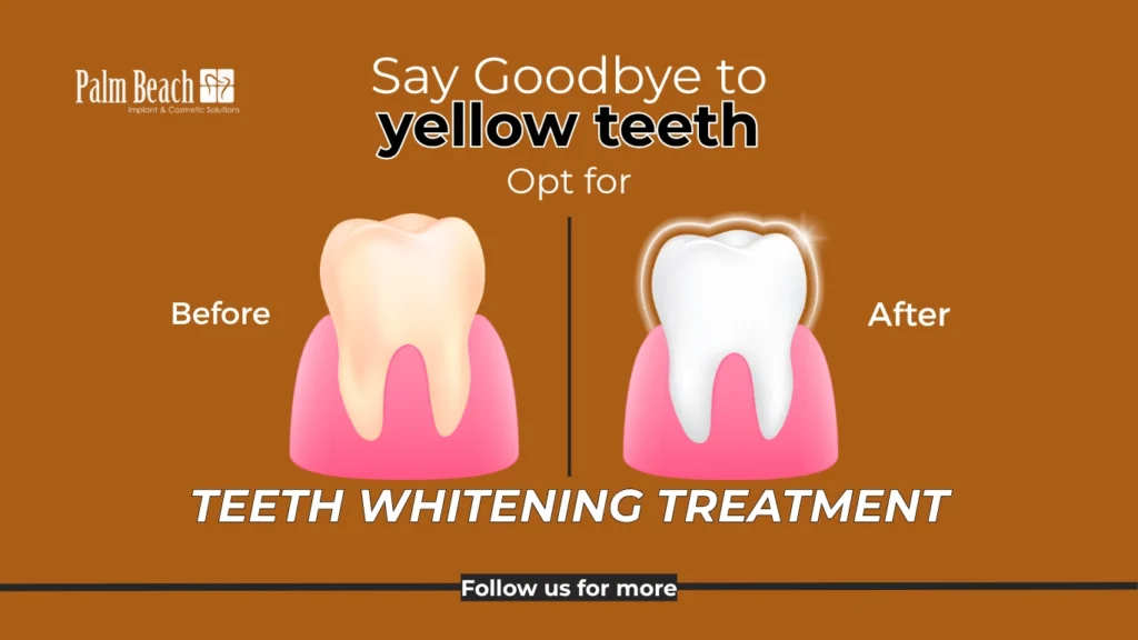 Palm Beach_Teeth Whitening