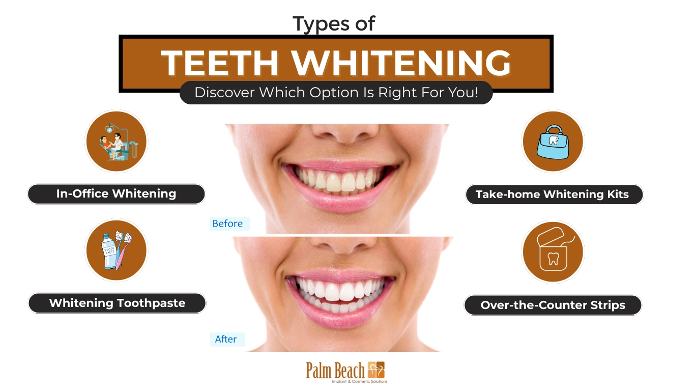 Palm beach-Types of teeth